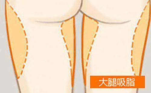 <strong>二、在郑州颜华医疗美容医院做孔德记医生隆鼻，大概要多少钱？</strong>