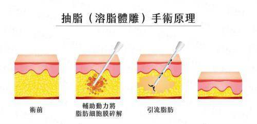 <strong>三、选择郑州颜华医疗美容医院的孔德记医生隆鼻，需要注意什么？</strong>