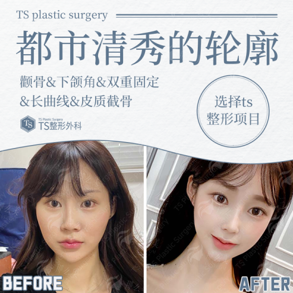 <strong>深圳维瑞假体隆鼻的价格区间与收费标准</strong>