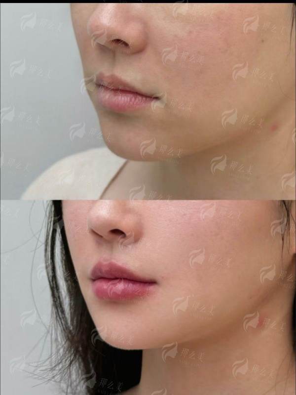 <strong>北京圣嘉新医疗美容口腔医院李春财面吸的特色仪器与治疗方式</strong>