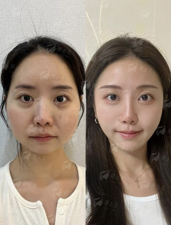<strong>北京艺美硕德王东脂肪隆胸核心技术优势详解</strong>