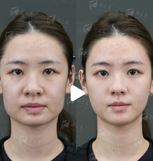 <strong>北京纯脂脂肪专科特色:从吸脂到填充的“一站式”闭环治疗</strong>