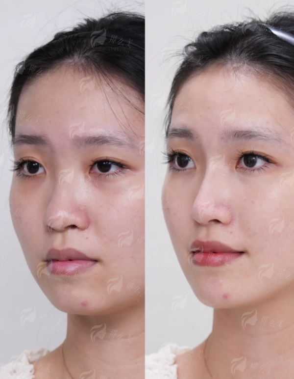 <strong>想找杭州芳华陈笑医生面诊眼整形,特色治疗与仪器有何加持?</strong>