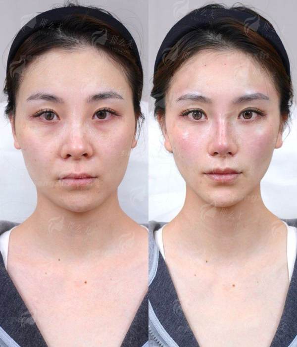 <strong>三、在浙江义乌欧莱美整形医院找周叶医生面诊，流程和价格是怎样的？</strong>