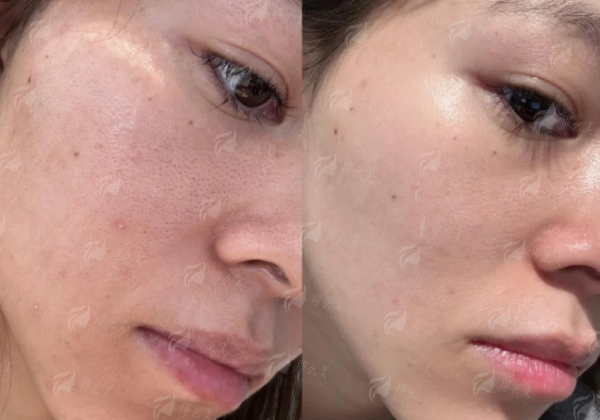 <strong>上海华美整形王荣锡3s小颜复位术的贴心服务与术后关怀</strong>