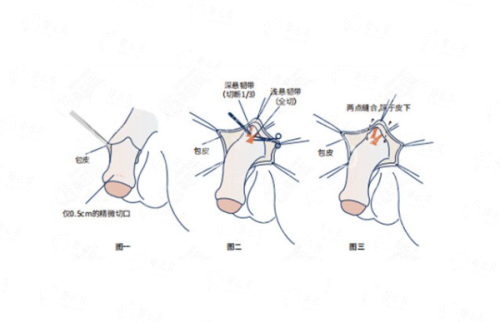 <strong>北京嘉禾整形王广的胸部失败修复特色技术详解</strong>