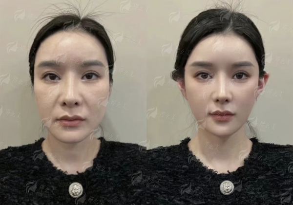 <strong>求美者更关心：线提升抗衰提升的价格与成效能维持多久？</strong>
