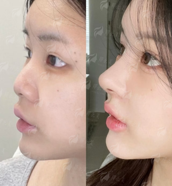 <strong>北京嘉禾整形王广胸部失败修复的口碑与患者评价如何?</strong>