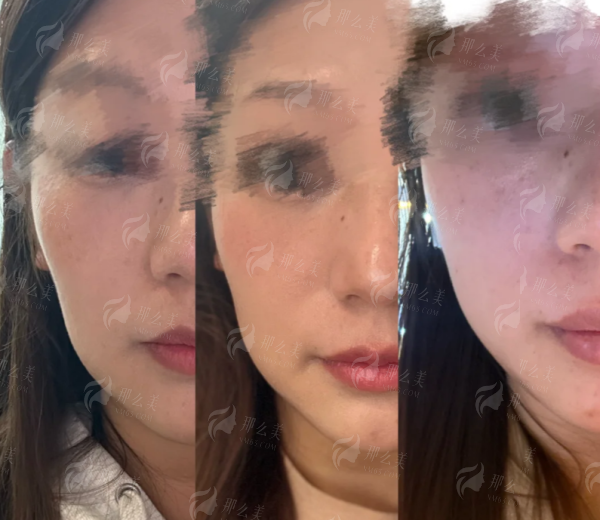 <strong>北京嘉禾整形在胸部提升术中使用哪些特色仪器?</strong>