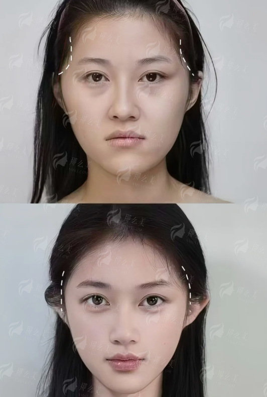 <strong>王广医生假体隆胸的价格区间与收费标准是怎样的？</strong>