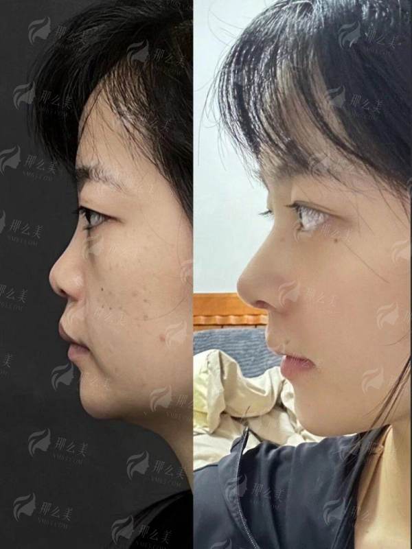 <strong>三、杜太超在北京黄寺整形外科医院做拉皮的真实术后反馈整理</strong>