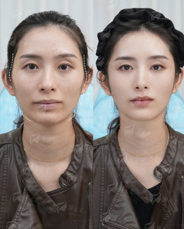 三、<strong>南京艺星医疗美容医院汪树杰做双眼皮修复价格贵吗?</strong>