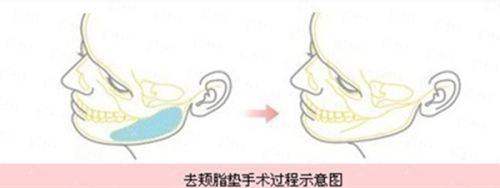 四、<strong>广州荔医医疗美容门诊部余东文怎么预约?</strong>